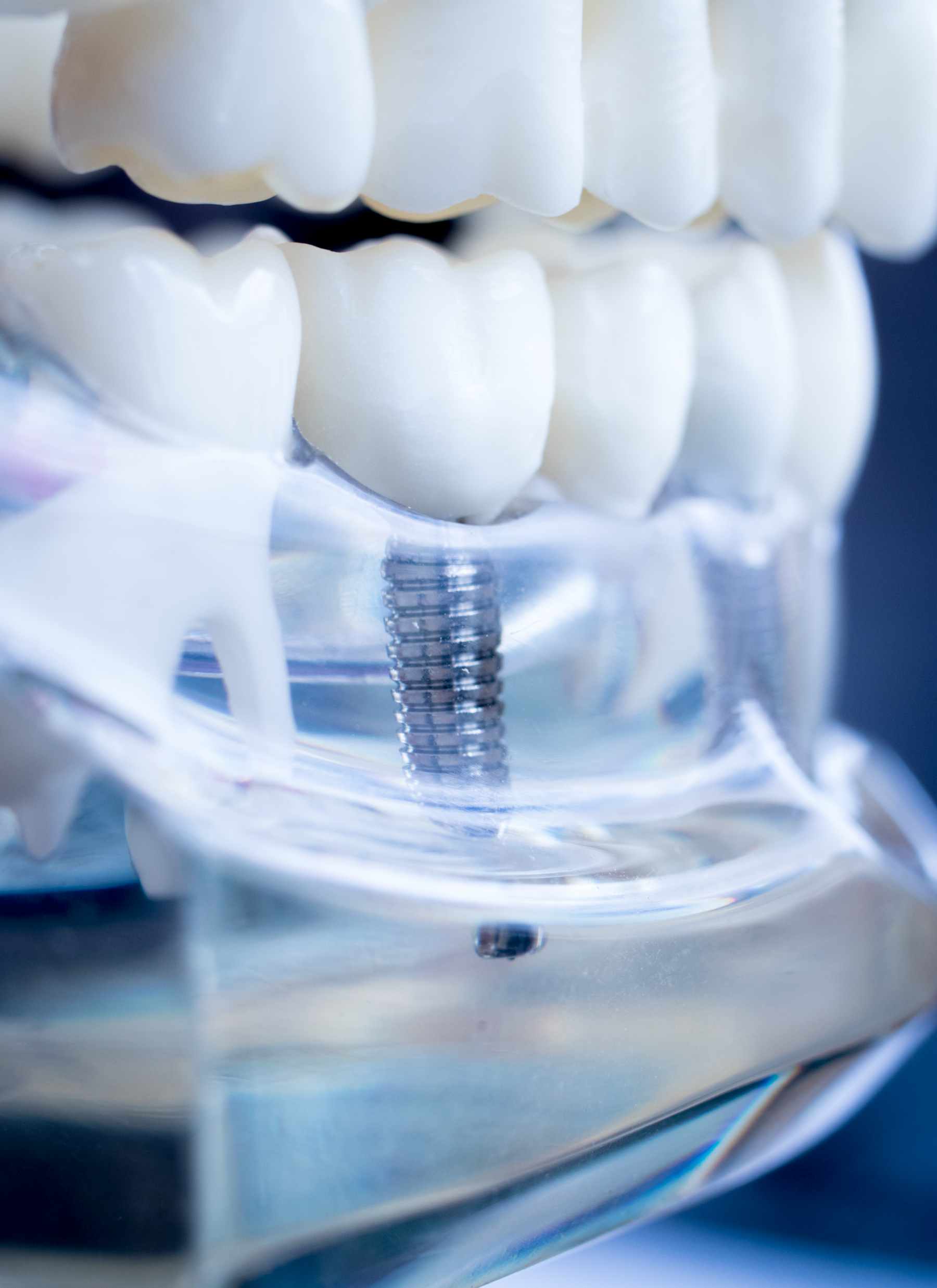 implantes dentales buenos baratos oñati implantes dentales buenos baratos oñati